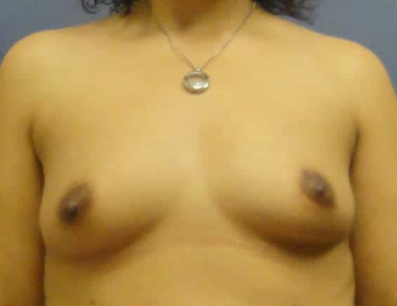 breast augmentation 2955 - Patient 32