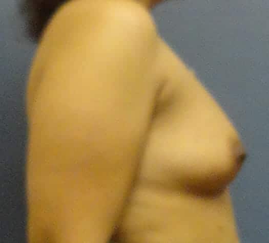 breast augmentation 2956 - Patient 32