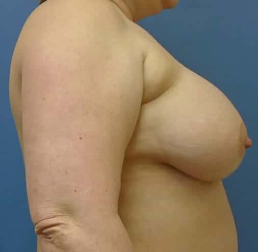 breast augmentation 2965 - Patient 41