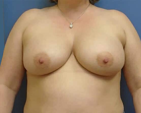 breast augmentation 2967 - Patient 41