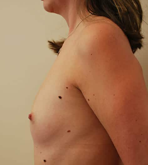 breast augmentation 3590 - Patient 10