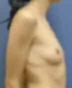 breast augmentation 3622 - Patient 46