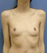 breast augmentation 3624 - Patient 46