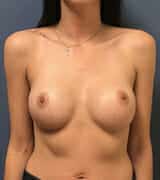 breast augmentation 3625 - Patient 46
