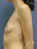 breast augmentation 3626 - Patient 46