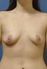breast augmentation 3628 - Patient 45