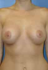 breast augmentation 3629 - Patient 45