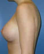 breast augmentation 3630 - Patient 45