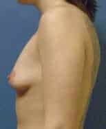 breast augmentation 3631 - Patient 45