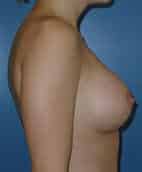 breast augmentation 3632 - Patient 45