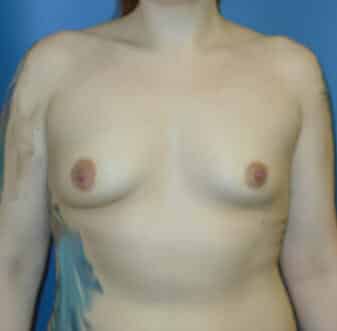 breast augmentation 3741 - Patient 19