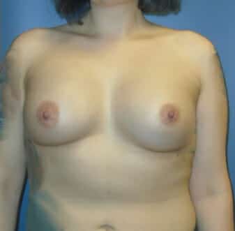 breast augmentation 3742 - Patient 19