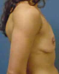 breast augmentation 3750 - Patient 31