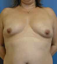 breast augmentation 3761 - Patient 9