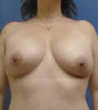 breast augmentation 3762 - Patient 9