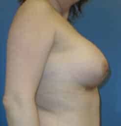 breast augmentation 3764 - Patient 9
