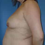 breast augmentation 3765 - Patient 9