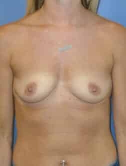 breast augmentation 3821 - Patient 8