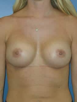 breast augmentation 3822 - Patient 8