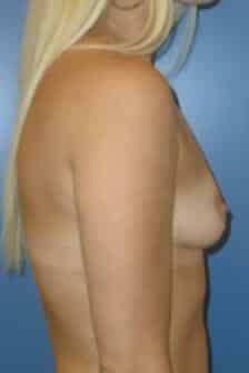 breast augmentation 3824 - Patient 8
