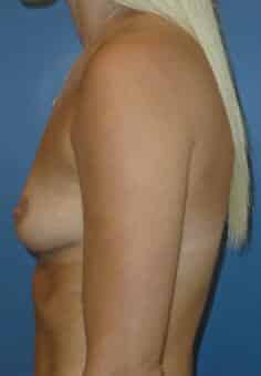 breast augmentation 3826 - Patient 8