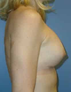 breast augmentation 3859 - Patient 7