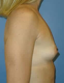 breast augmentation 3860 - Patient 7