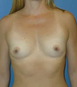 breast augmentation 3861 - Patient 7