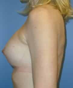 breast augmentation 3863 - Patient 7