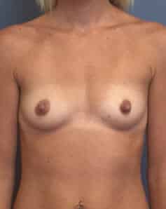 breast augmentation 3872 - Patient 6