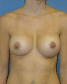 breast augmentation 3874 - Patient 6