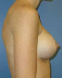 breast augmentation 3875 - Patient 6