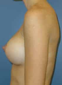 breast augmentation 3876 - Patient 6