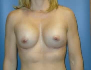 breast augmentation 3956 - Patient 5