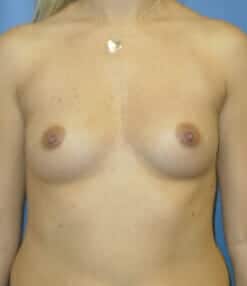 breast augmentation 3972 - Patient 4