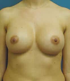 breast augmentation 3973 - Patient 4
