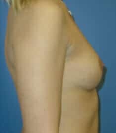 breast augmentation 3974 - Patient 4