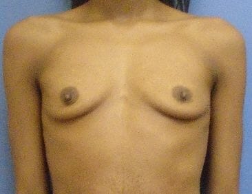 breast augmentation 4064 - Patient 3