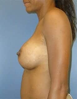 breast augmentation 4660 - Patient 1