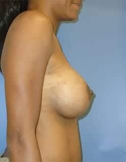 breast augmentation 4661 - Patient 1