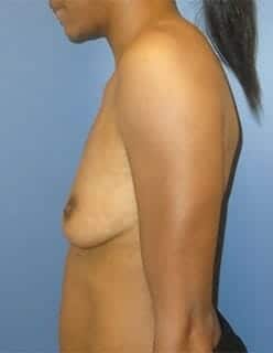 breast augmentation 4662 - Patient 1