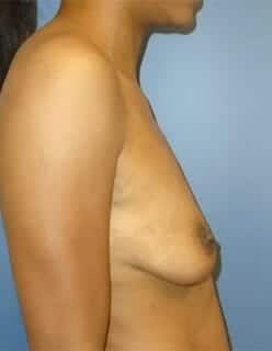 breast augmentation 4663 - Patient 1