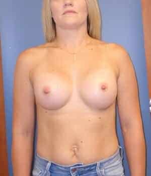 breast augmentation 5107 - Patient 2