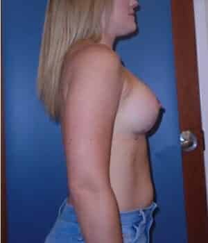 breast augmentation 5109 - Patient 2