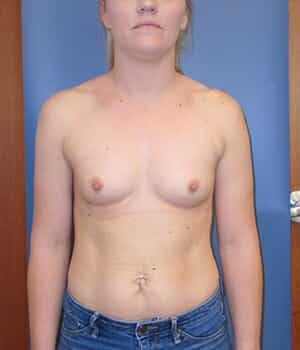 breast augmentation 5110 - Patient 2