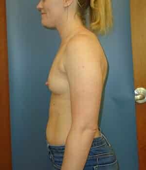 breast augmentation 5111 - Patient 2