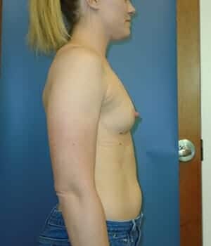 breast augmentation 5112 - Patient 2