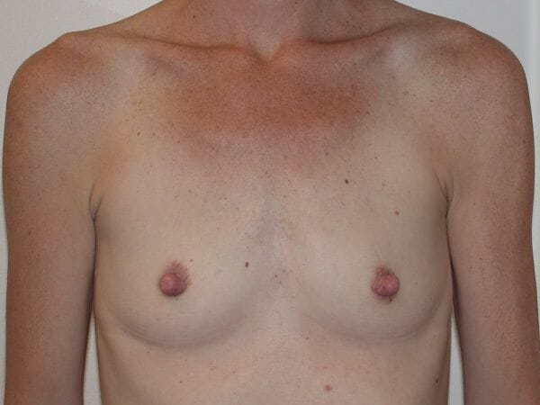 breast augmentation 585 - Patient 11