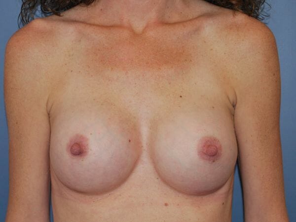 breast augmentation 586 - Patient 11