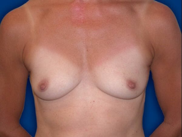 breast augmentation 594 - Patient 13
